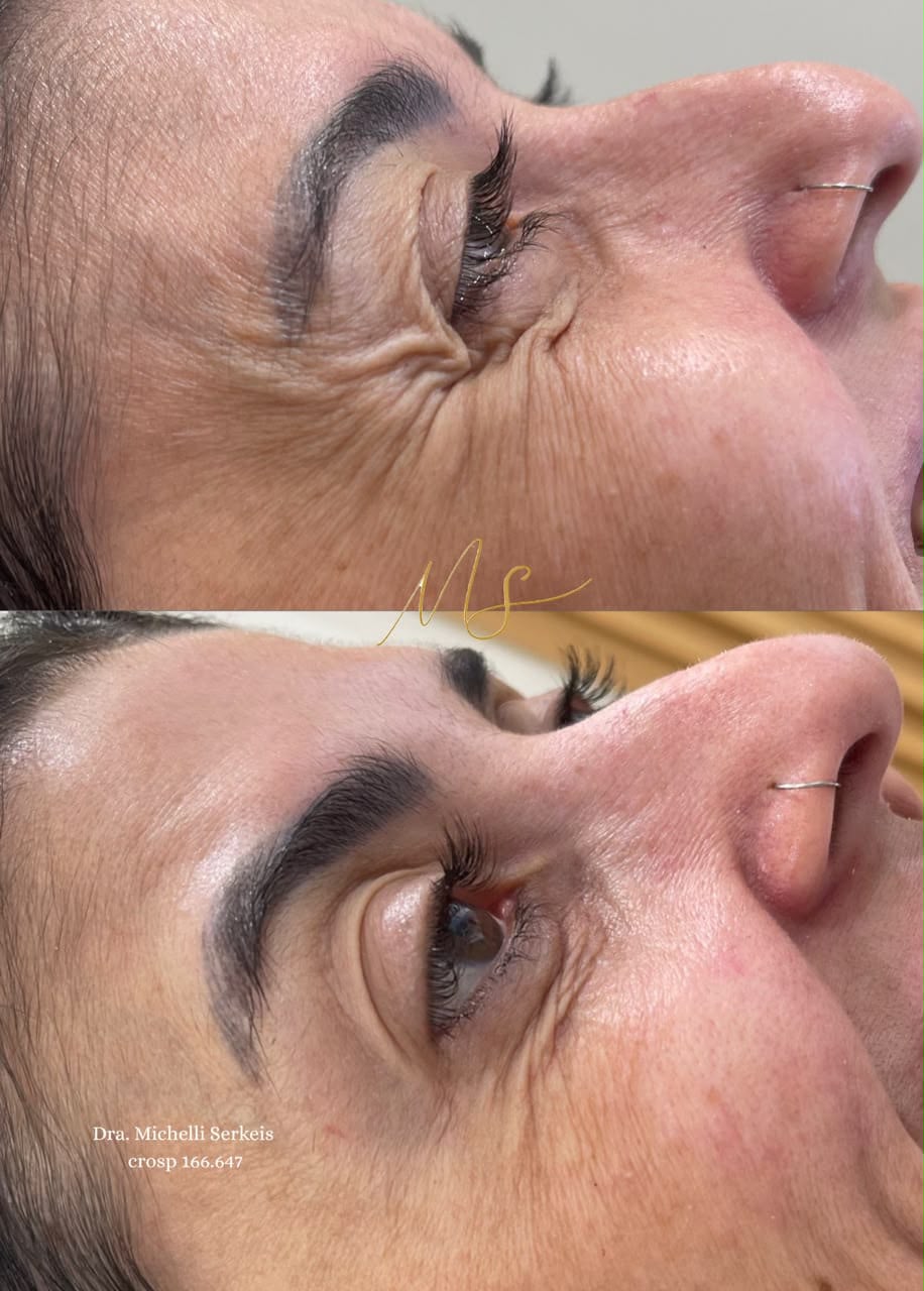 Registro clínico original de botox feminino