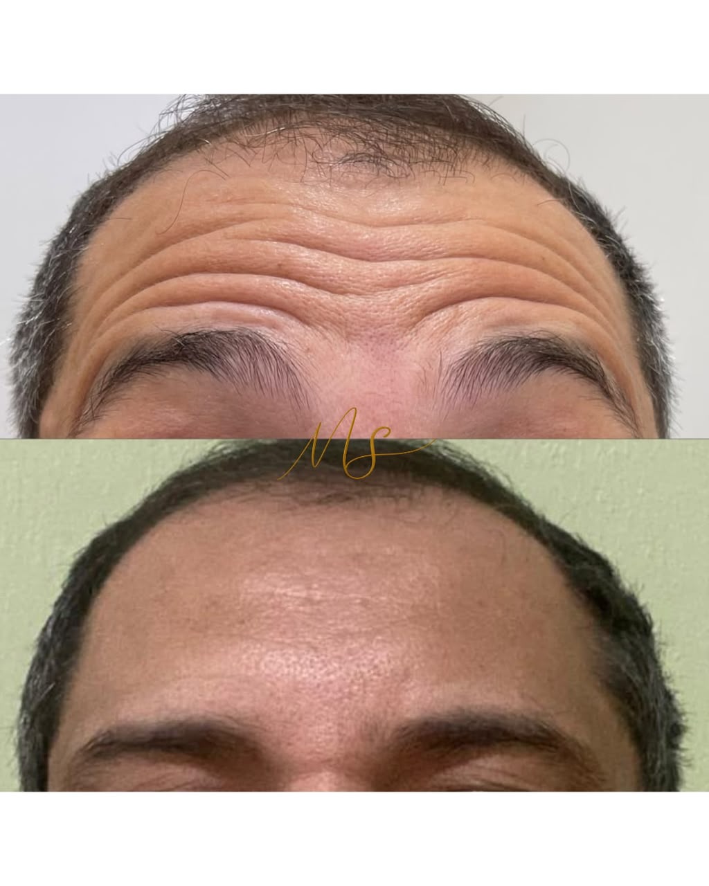 Registro clínico original de botox masculino