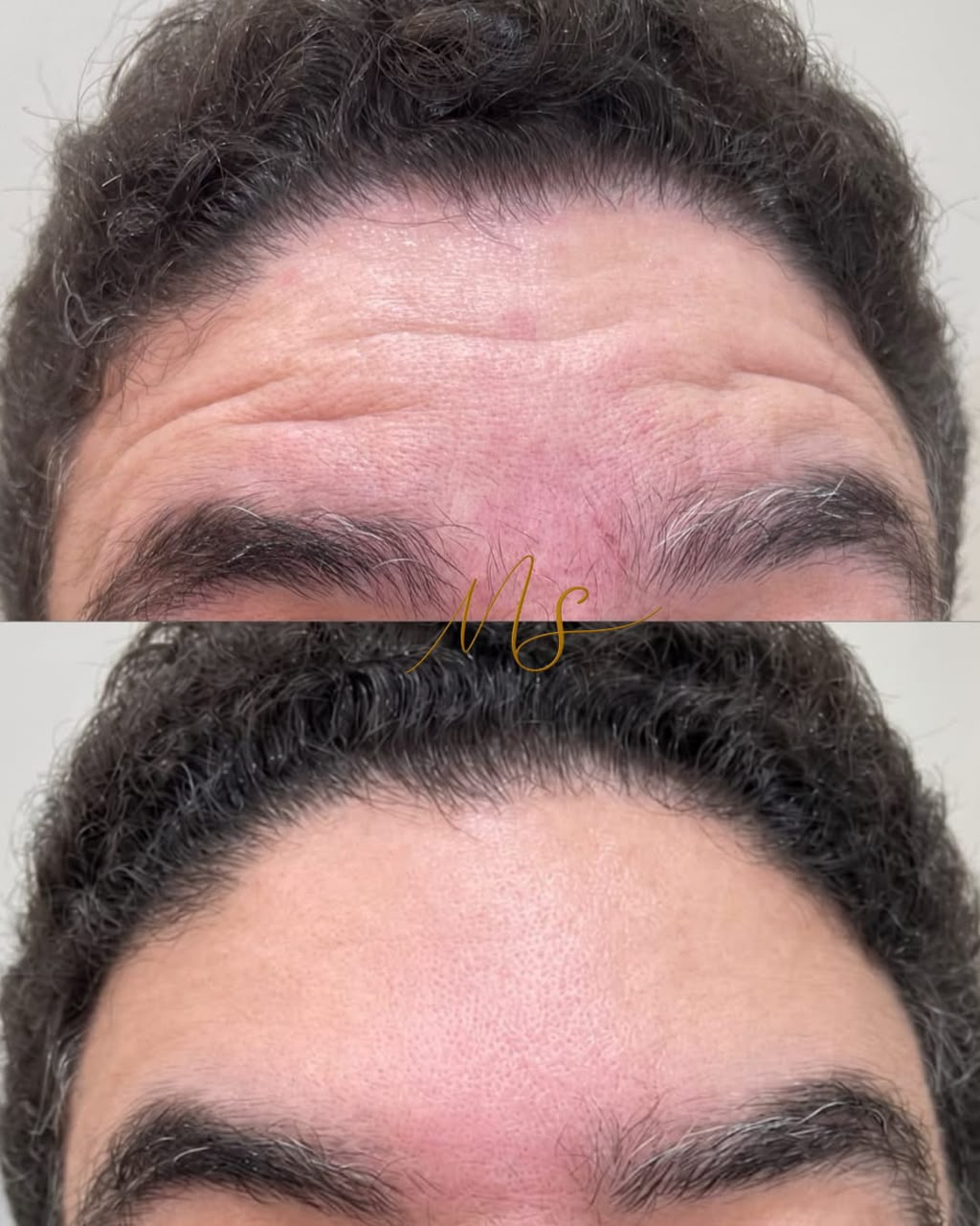 Registro clínico original de botox masculino