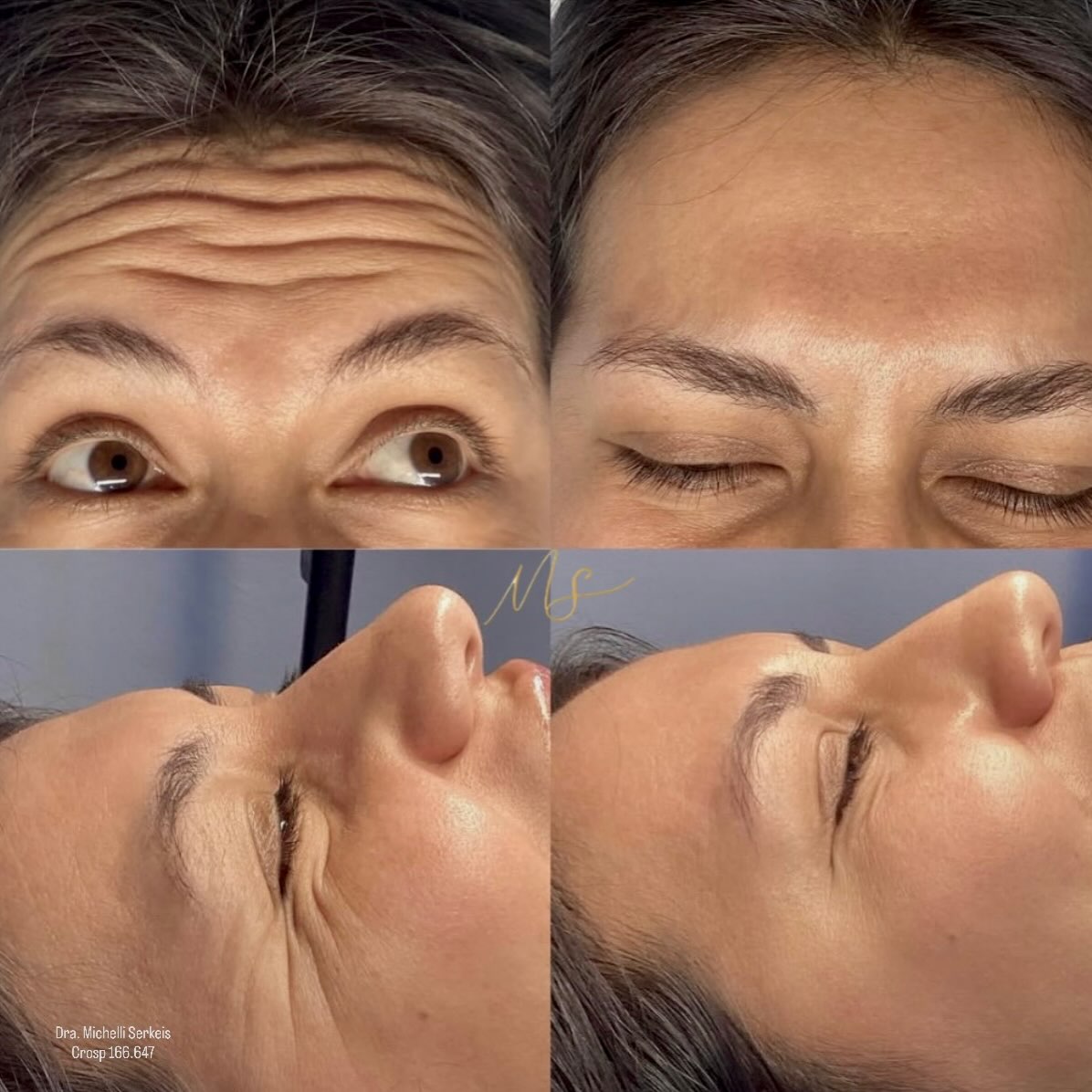 Registro clínico original de botox feminino