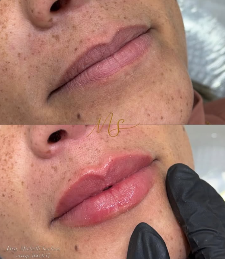 Registro clínico original de preenchimento labial