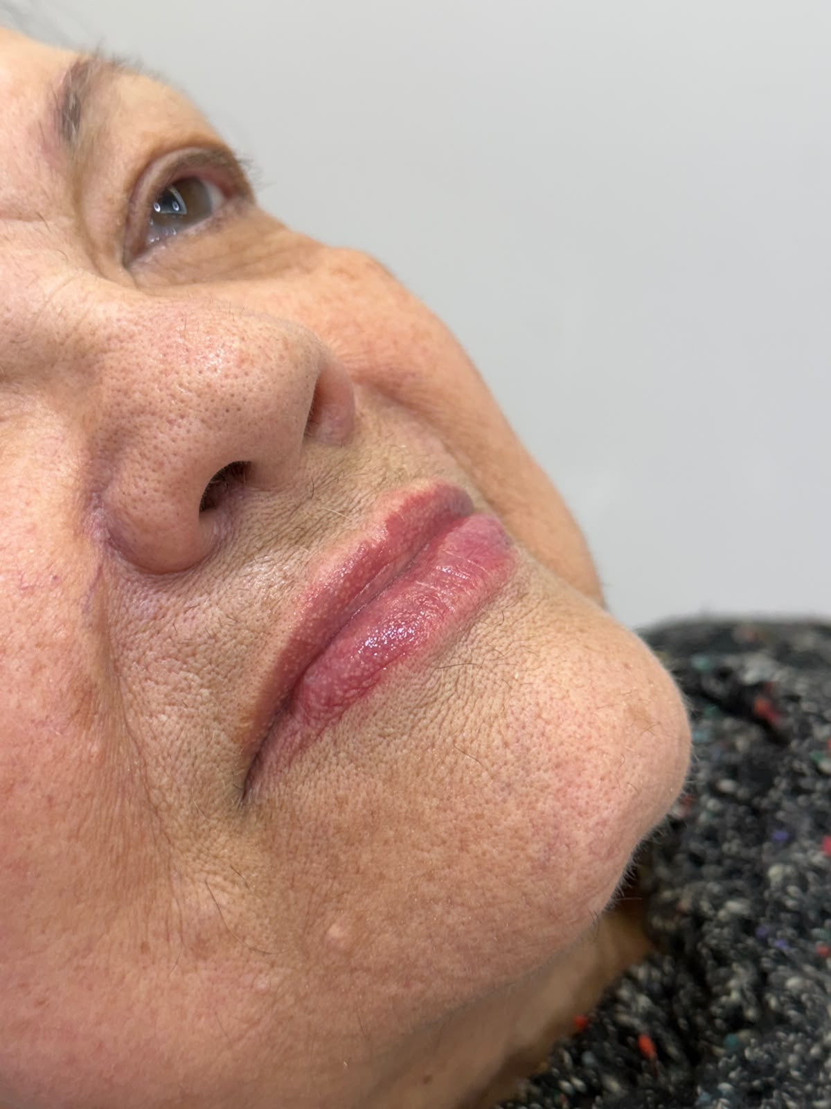 Registro labial em perfil. — composição clínica original enviada pela doutora