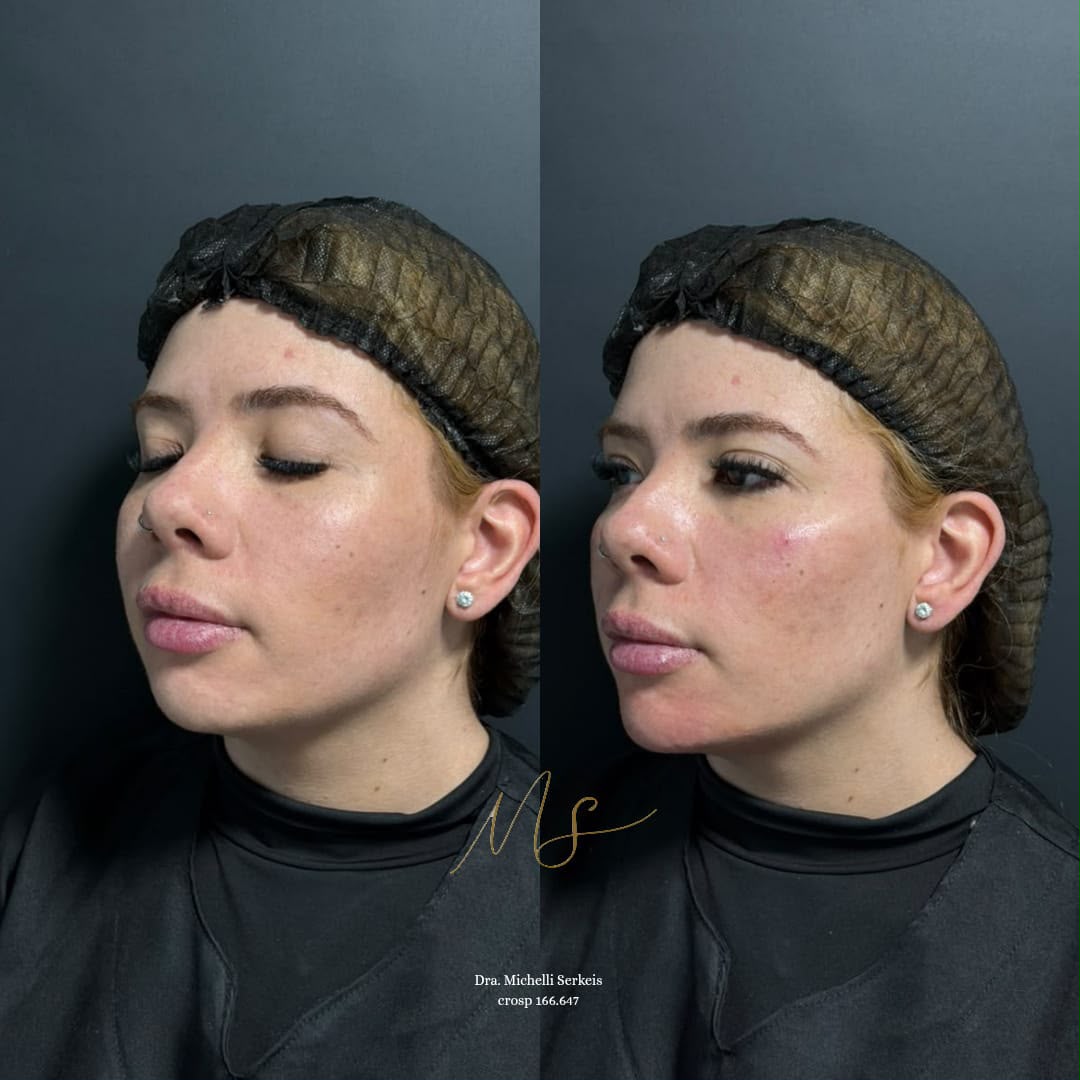 Registro clínico original de perfiloplastia